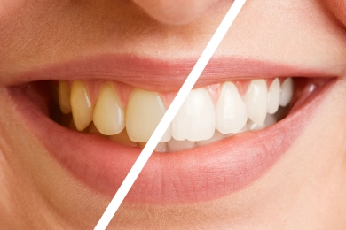 Clareamento Dental